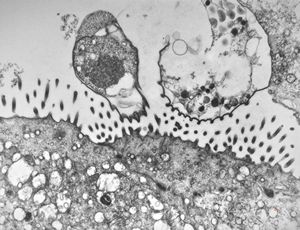 M,33y. | microsporidiosis (or cryptosporidiosis) - duodenum-posttransplantation immunodeficiency M,33y. | microsporidiosis (or cryptosporidiosis) - duodenum-posttransplantation immunodeficiency